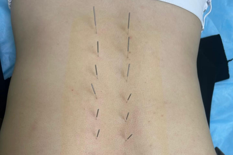 Shanghai: Chinese Medicine Acupuncture and Cupping Session