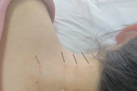 Shanghai: Chinese Medicine Acupuncture and Cupping Session