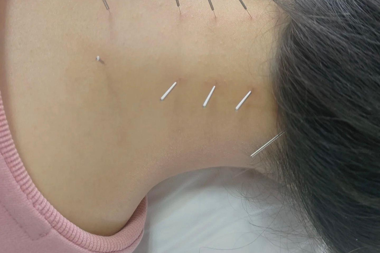 Shanghai: Chinese Medicine Acupuncture and Cupping Session