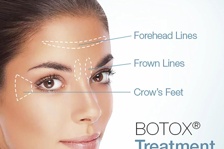 Tbilisi: Private Full-Face Botox with Hotel Pickup, optional