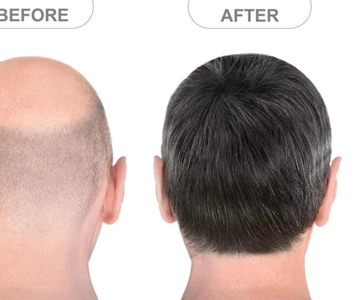 INDIA: Hair Transplant with Sightseeing Tour